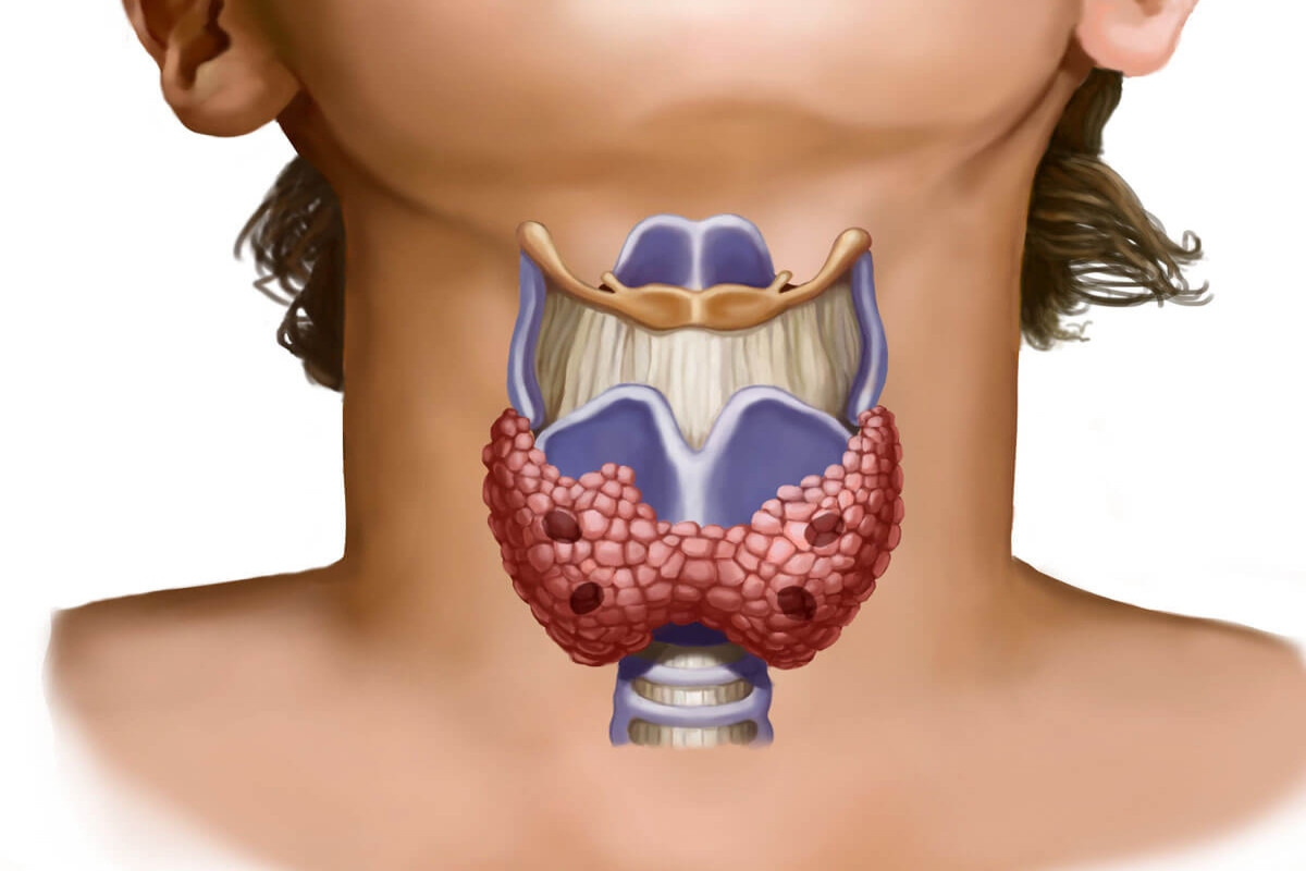 Зобом является. Диффузный зоб щитовидка. Иммунный токсический зоб. Токсический зоб щитовидной железы.